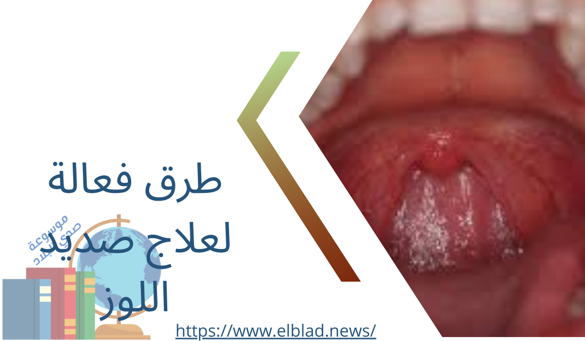 طرق فعالة لعلاج صديد اللوز