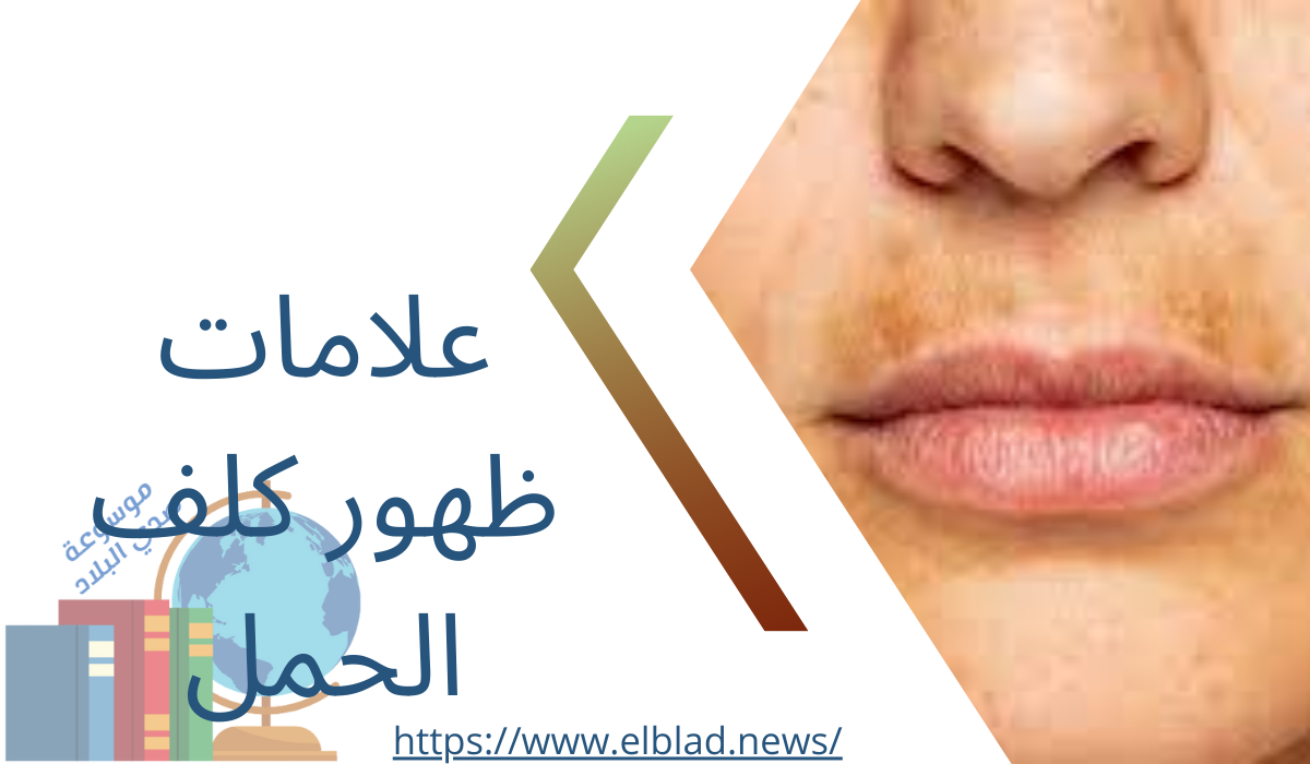 علامات ظهور كلف الحمل