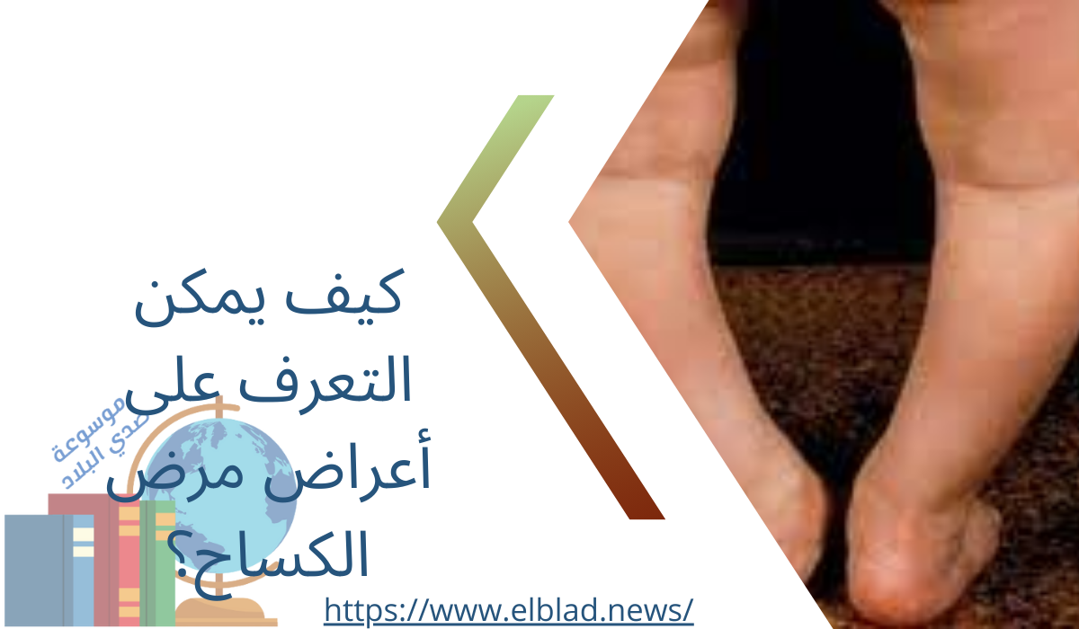 كيف يمكن التعرف على أعراض مرض الكساح؟