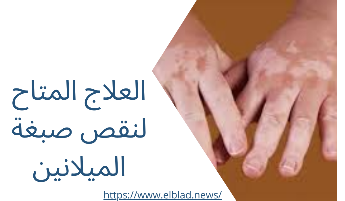 العلاج المتاح لنقص صبغة الميلانين