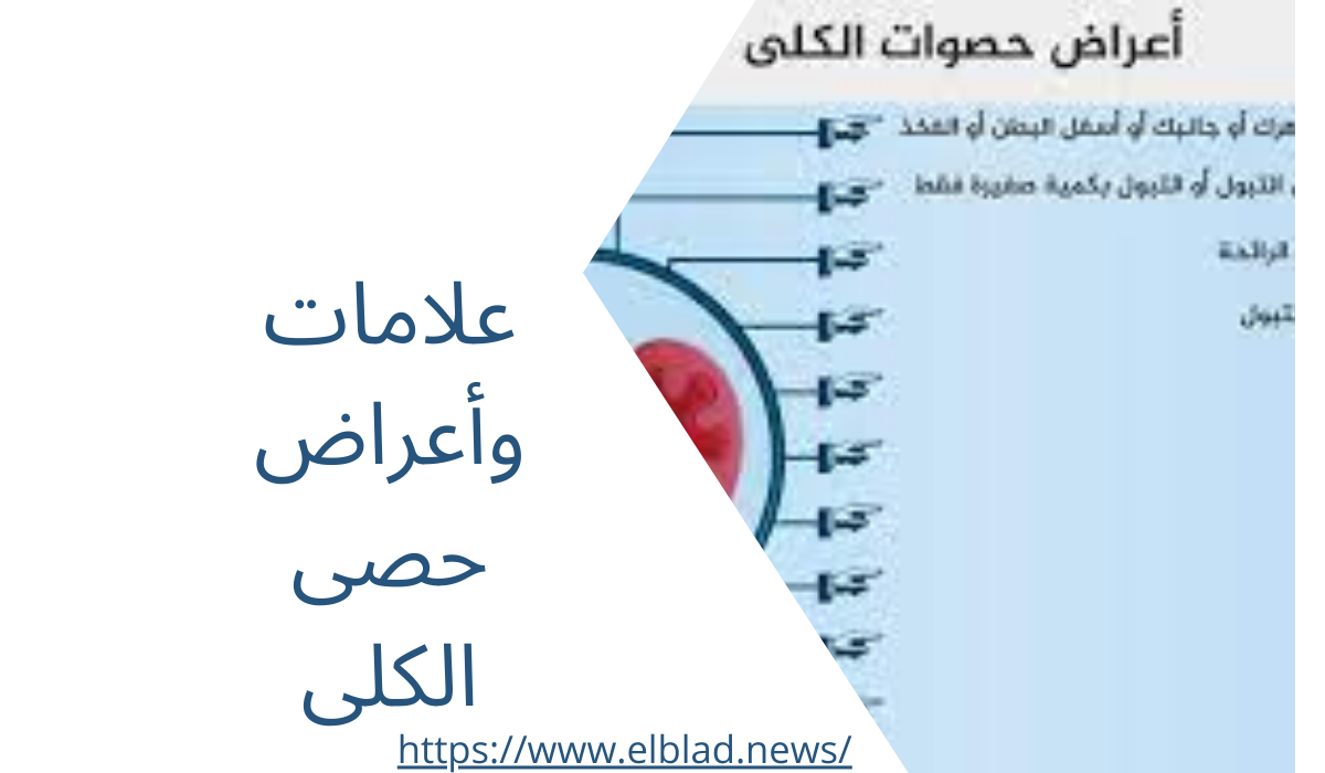 علامات وأعراض حصى الكلى