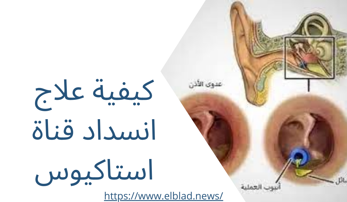 كيفية علاج انسداد قناة استاكيوس